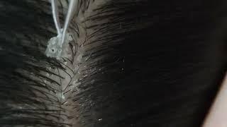 Relaxing dandruff removal (w/ tweezers) #21 02sleepyheads | ASMR #oddlysatisfying