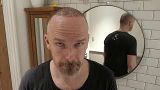 MY HAIR TRANSPLANT - Day 10 and 14