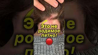 Родимое Пятно?  Нет!