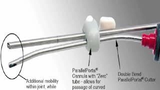 Single Portal Knee Arthroscopy: 2015 Technique Update