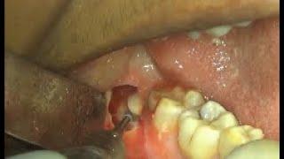 Deeply impacted horizontal impacted wisdom teeth removal  multiple sectioning