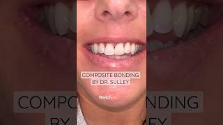 Composite bonding by Dr. Sulley  #ruhdental