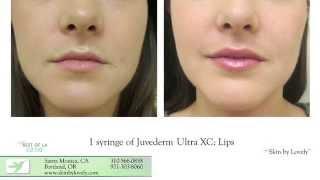 Lip Enhancement Options at Skin by Lovely