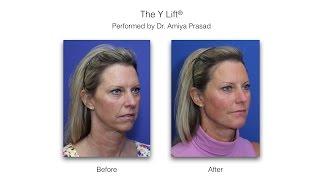 Facelift without Surgery, and Adding Facial Volume at a Deeper Level - Y Lift® by Dr. Amiya Prasad