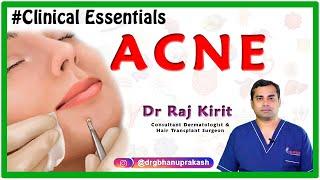 Acne/Pimples: Causes, Types, Pathogenesis, Clinical Features, and Treatment (Clinical Essentials)