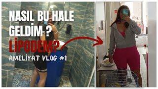 Lipödem nedir? Nasıl fark ettim? Tedavisi nedir? #lipödem #ameliyat #doctor #vlog