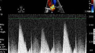 PHT with a Bio Valve