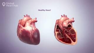 (English) - Heart Failure Awareness Week - Campaign Animation