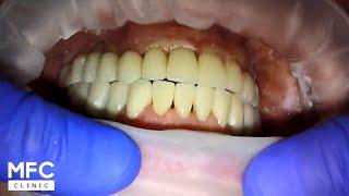 Имплантация зубов. Надеваем коронки на всю верхнюю челюсть! Crowns on the upper jaw (on implants)上頜冠