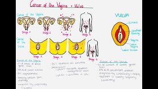 Cancer of the Vagina and Vulva - symptoms, diagnosis, staging, treatment, prognosis
