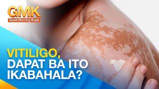 VITILIGO: Causes and Treatments Explained by Dermatologist | Usapang Pangkalusugan