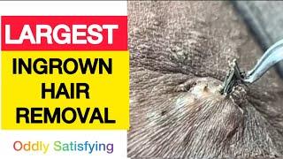 Largest Ingrown Hair Removal | Oddly Satisfying Hair Extraction|