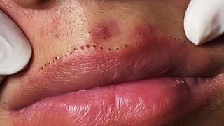 Lips Blackhead removal Video #53 #Blackheads #blackheadsremoval #sebum
