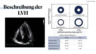 〖Echokardiografie〗 LVH des linken Ventrikels🫀