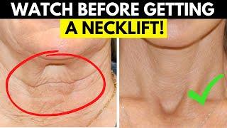 Sagging Neck and Considering Surgery? WATCH this before getting surgery to fix your neck!