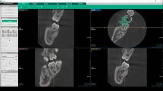 Software Ez3D-i : Modalità endodontica