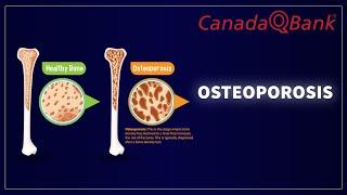 Osteoporosis