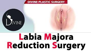 Labiaplasty Surgery | Labia Majora Reduction | Vagina Tightening In Delhi 2021 | Labia Majoraplasty