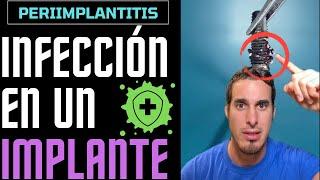 Si llevas IMPLANTES DENTALES esto te interesará - INFECCIÓN DE IMPLANTE o PERIIMPLANTITIS