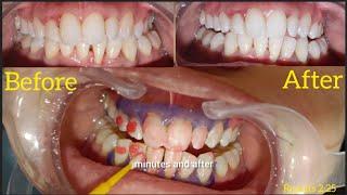 Does tooth whitening actually work? | daanton ko safed kaise karein | teeth whitening in 20 mins