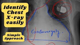 How to read a Chest Xray ?