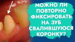 С зуба свалилась коронка. Что делать?