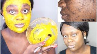 DIY TURMERIC FACE MASK | BEST ACNE TREATMENT | GET CLEAR, BRIGHT AND ACNE FREE SKIN IN 7 DAYS