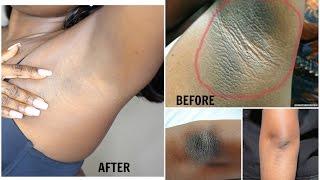 HOW TO LIGHTEN DARK UNDERARM  NATURALLY AND FAST |  PERMANENT RESULTS