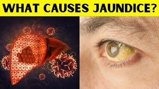 Uncover the Untold Reasons Behind Jaundice |Hidden Causes of Jaundice You Need to Know