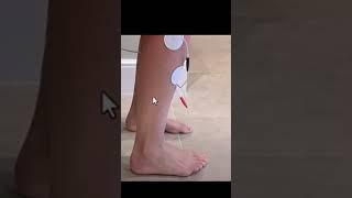 TENS Unit for Foot Drop