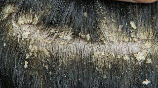 Scratching big dandruff off scalp | Dandruff scratching  and combing #005