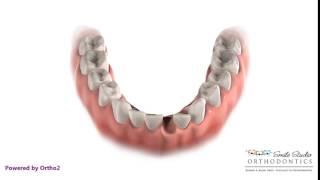 Orthodontic Treatment - Extraction of Lower Incisor
