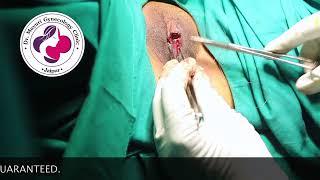 This is How Labiaplasty Surgery - Labia Minora Reduction is Operated Safely by Dr Mayuri Kothiwala