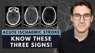 How to read a CT brain scan: Acute ischaemic stroke for beginners