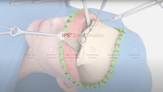 IPS® Transformation | Facial Feminization Surgery
