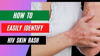 How to Identify an HIV Rash?