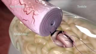 Epididymovasostomy - Mayo Clinic