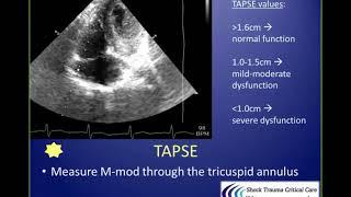 Echocardiographic Evaluation of Right Ventricular dysfunction