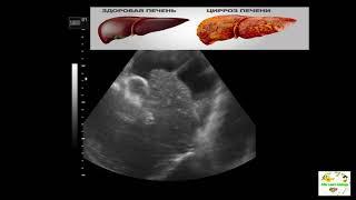УЗИ печени .Цирроз печени .Асцит.Нити фибрина. Печеночная связка.