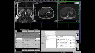 Adrenal Gland (Dynamic Study)