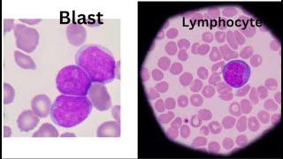 Lymphocyte or Blast ? | How do you tell the difference?