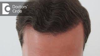 Are Hair Transplant results permanent? - Dr. Niranjana Raj