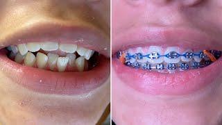 Braces on - 2 years with braces - Tongue Crib RPE - Tooth Time Family Dentistry New Braunfels Texas