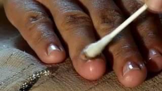 How to Cure Nail Fungus