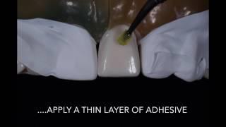 Porcelain Veneer Cementation step by step technique