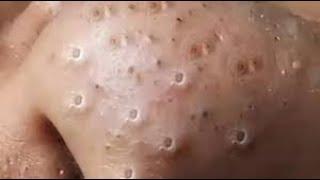 blackheads new this week