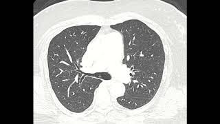 Tracheal bronchus