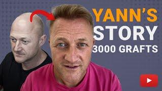 Amazing Transformation With A 3000 Grafts Hair Transplant
