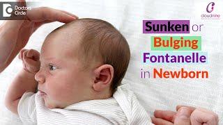 Bulging & Sunken Soft Spots on Baby's Head - Dr.Seema Gaonkar of Cloudnine Hospitals|Doctors' Circle