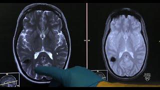 Cavernous malformations — Neurovascular disease explained